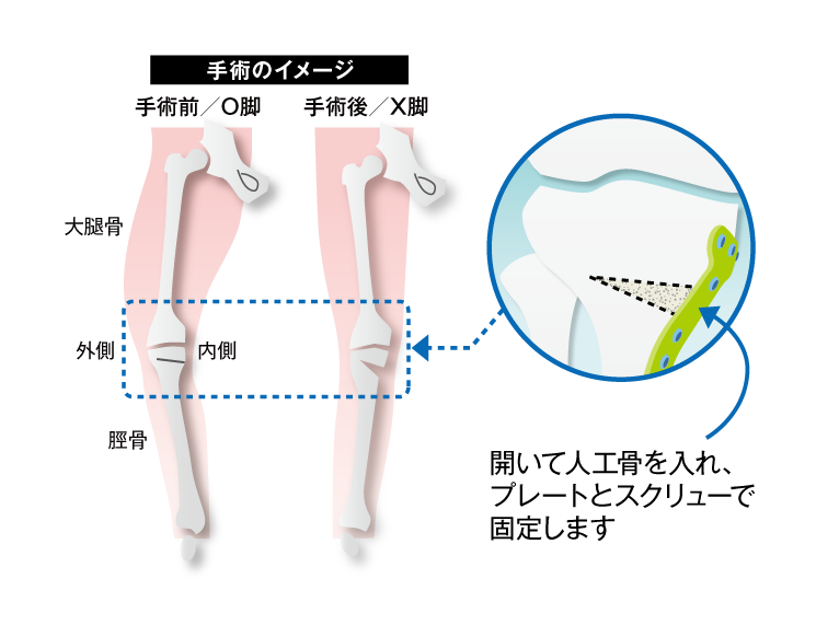 スポーツ復帰を目指した 膝周囲骨切り術 | お医者さんのコラム | ひざの痛みと治療方法