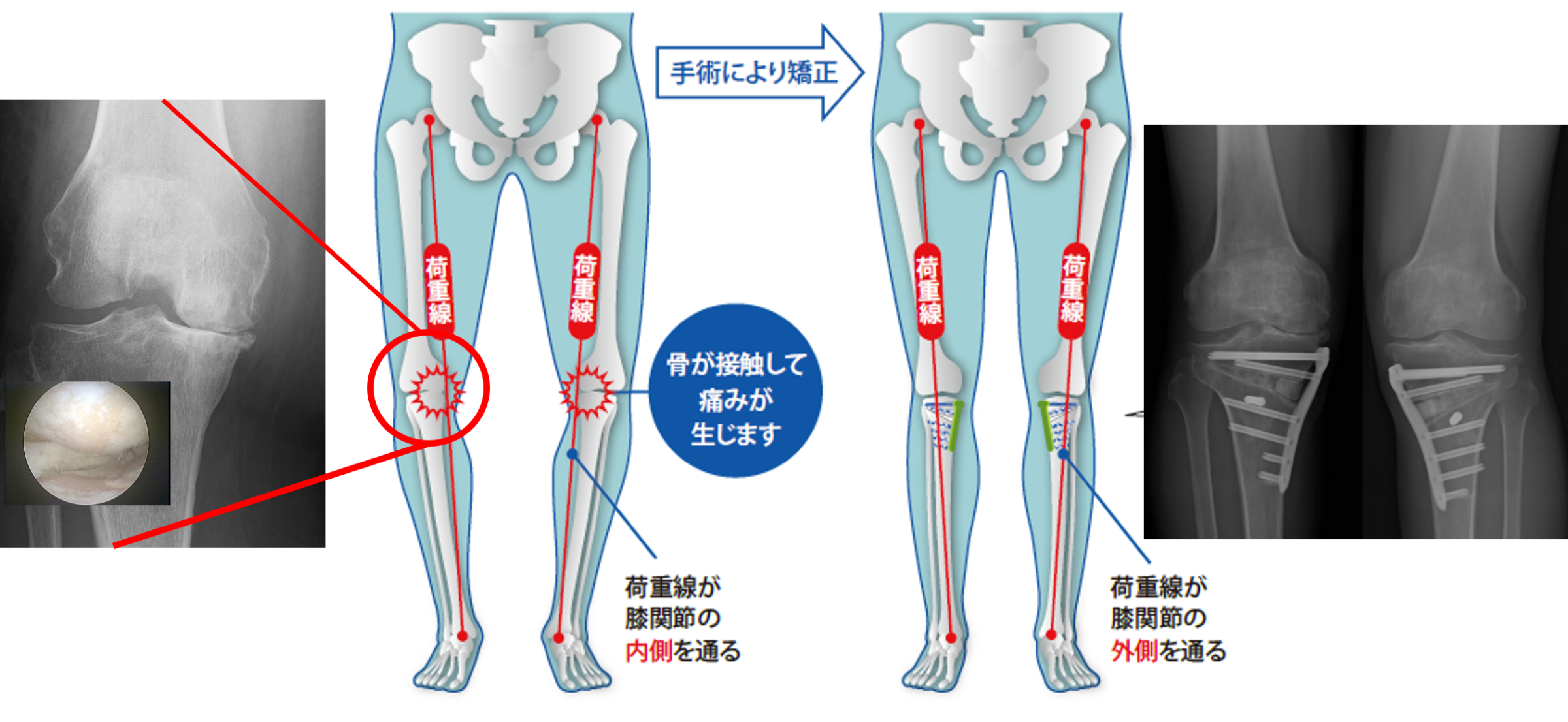 早期変形性膝関節症に対する膝周囲骨切り術の良いタイミングとそのメリット | お医者さんのコラム | ひざの痛みと治療方法