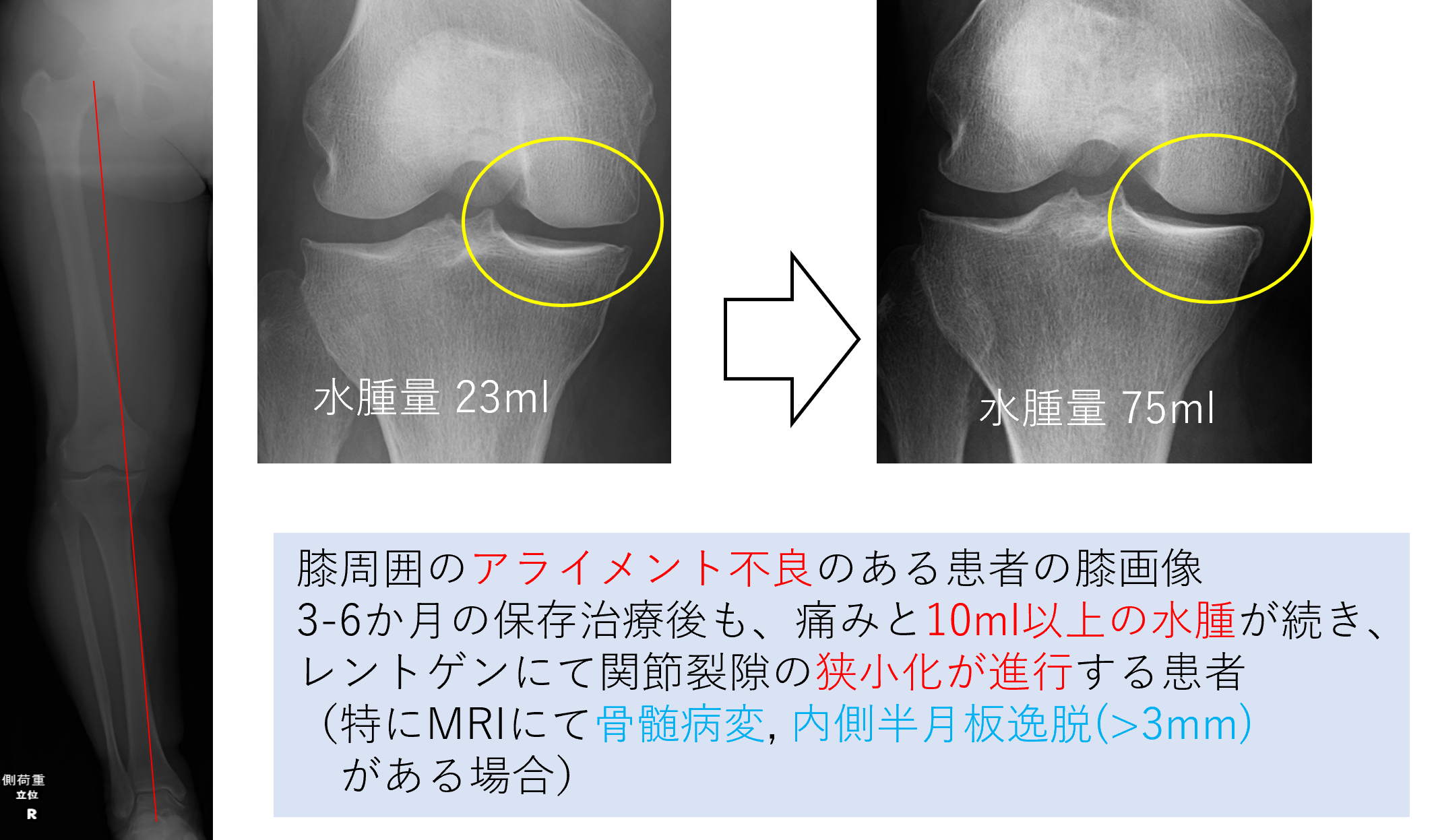 早期変形性膝関節症に対する膝周囲骨切り術の良いタイミングとそのメリット | お医者さんのコラム | ひざの痛みと治療方法